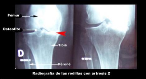 Radiografía de rodillas con Gonoartritis